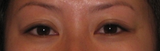 No wrinkles with smiling after Botox Treatment.